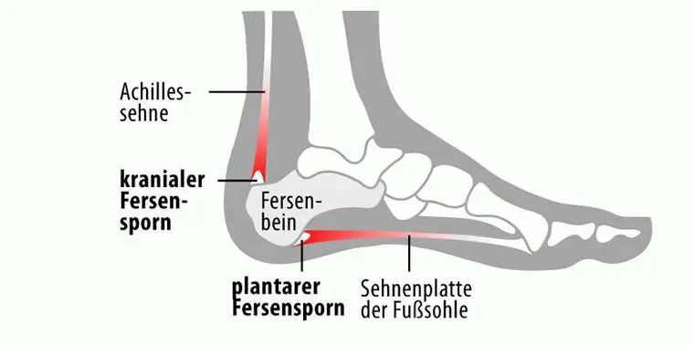 Illustration des Haglund-Syndroms mit Vergleich zwischen normalem und vergrößertem Fersenbein (Calcaneus) sowie Darstellung der Achillessehne – medizinische Grafik für Therapie und Diagnostik | Astar Therapiegeräte
