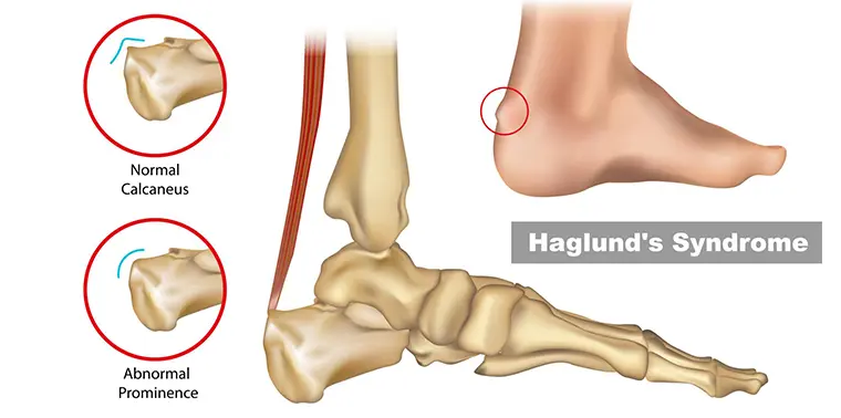 Lasertherapie am Beispiel des Haglundsyndroms