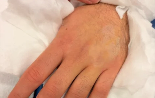 Lasertherapie für einen Mittelhandknochen - Bild der Handfraktur - Astar Therapiegeräte