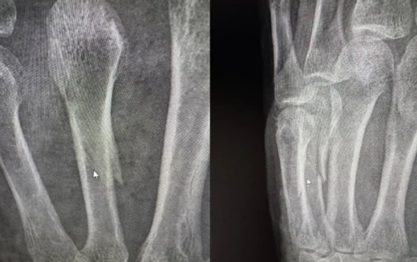 Lasertherapie für einen Mittelhandknochen - Röntgenbild der Handfraktur - Astar Therapiegeräte