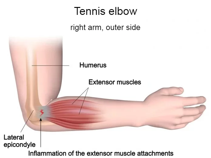 Anatomische Darstellung eines Tennisellenbogens mit entzündetem Sehnenansatz der Unterarmstreckmuskulatur am äußeren Ellenbogen - Astar Therapiegeräte