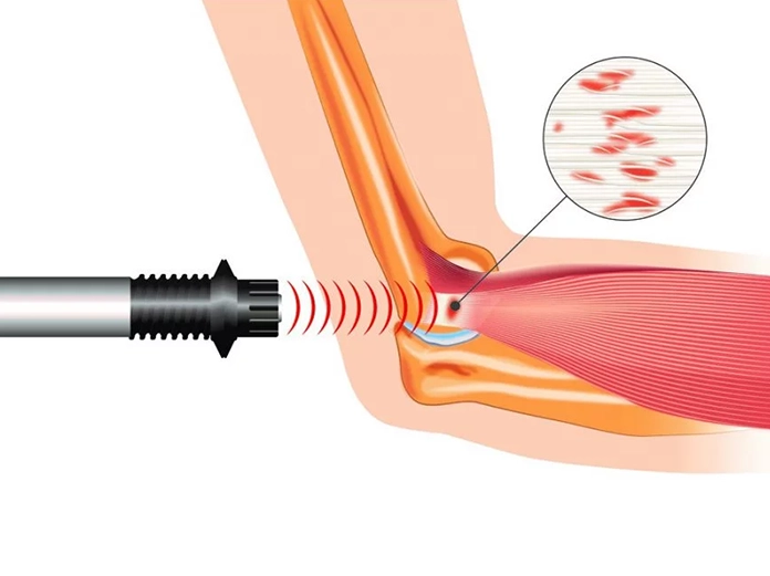 Anatomische Darstellung eines Tennisellenbogens mit entzündetem Sehnenansatz der Unterarmstreckmuskulatur am äußeren Ellenbogen - Astar Therapiegeräte
